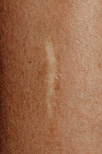 close up of a scar